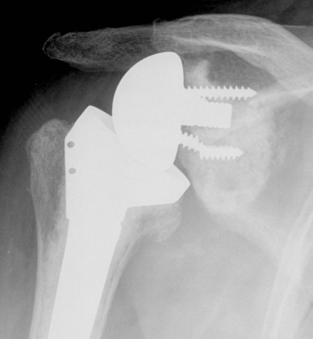 Failed Glenoid Reverse TSR